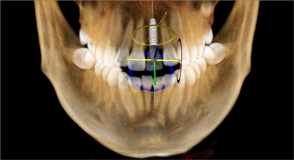 InVivo dental implant planning software image