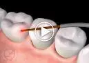 Periodontal disease YouTube video link